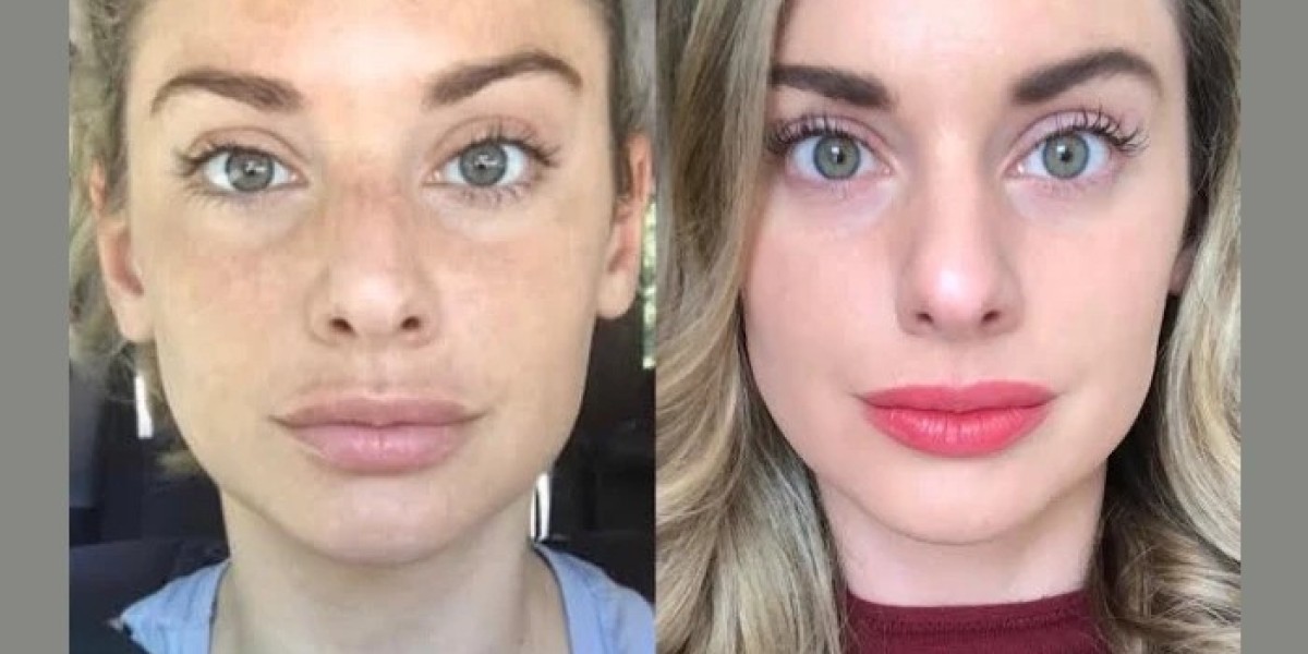 Book the Best Plastic Surgeon in Dubai for RF Microneedling Today