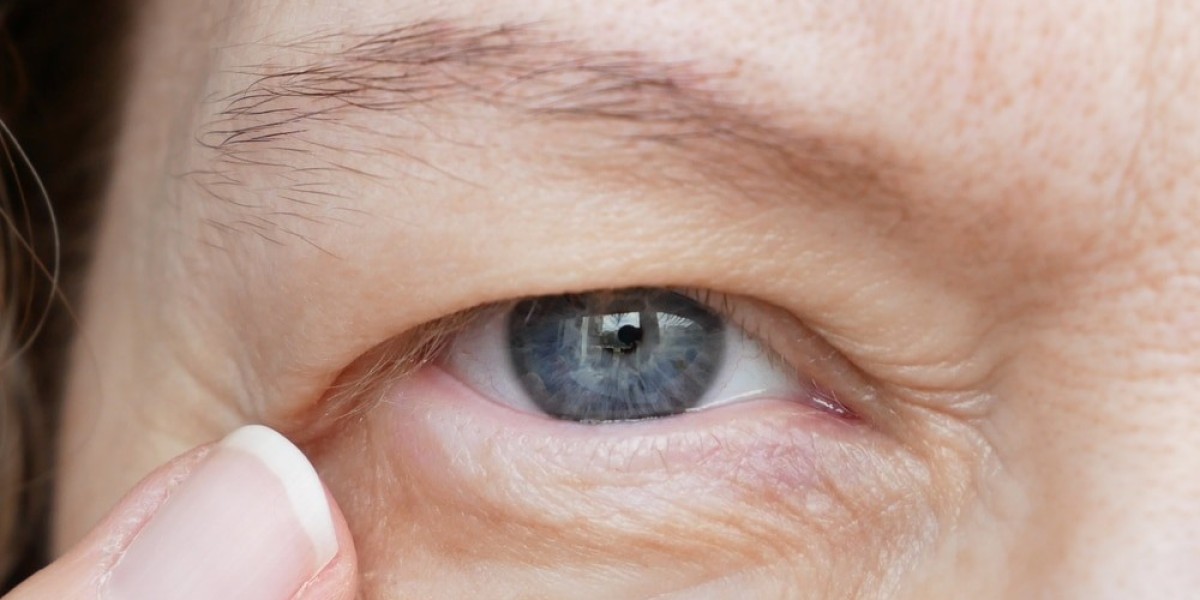 Benefits of Eyelid Bag Surgery Dubai for Youthful Eyes