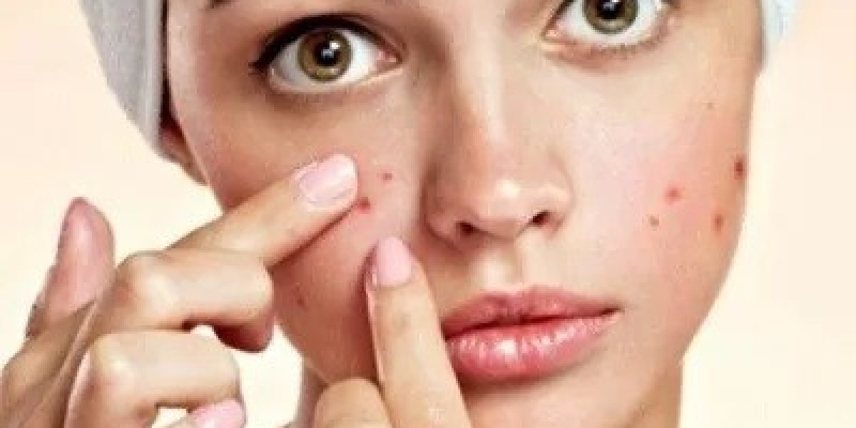Your Guide to Successful Acne Treatment in Islamabad