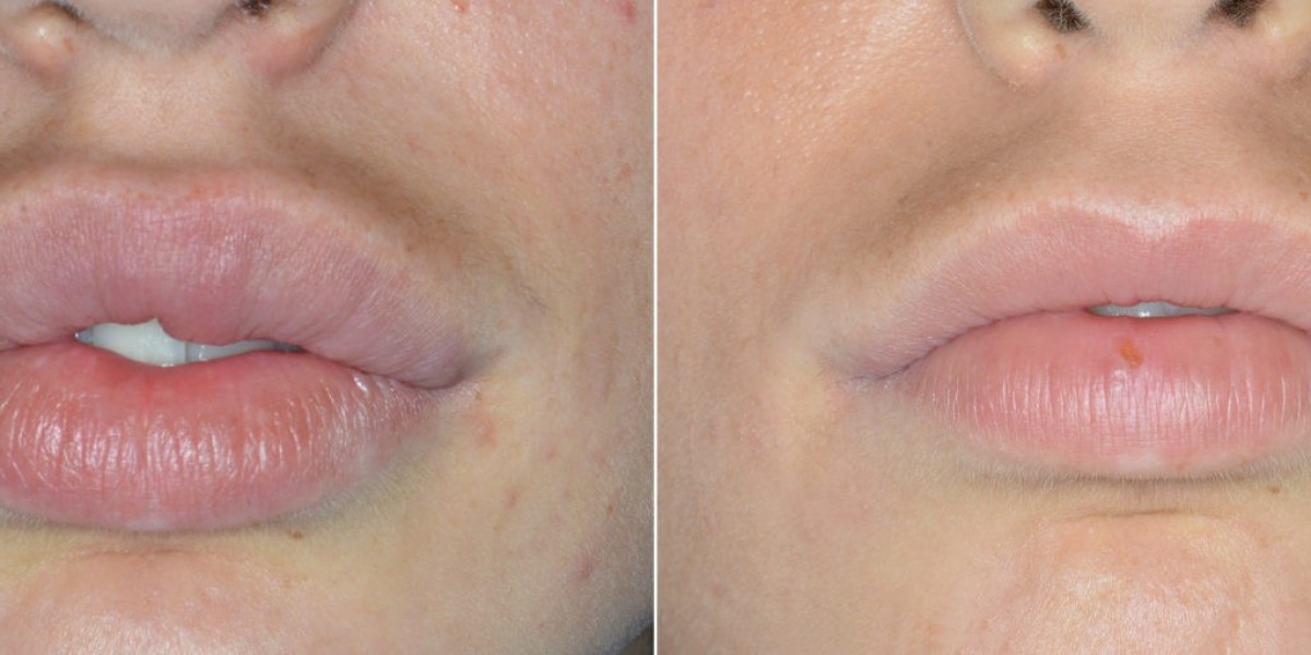 Enhance Your Smile: Professional Lip Enlargement Trends in Riyadh
