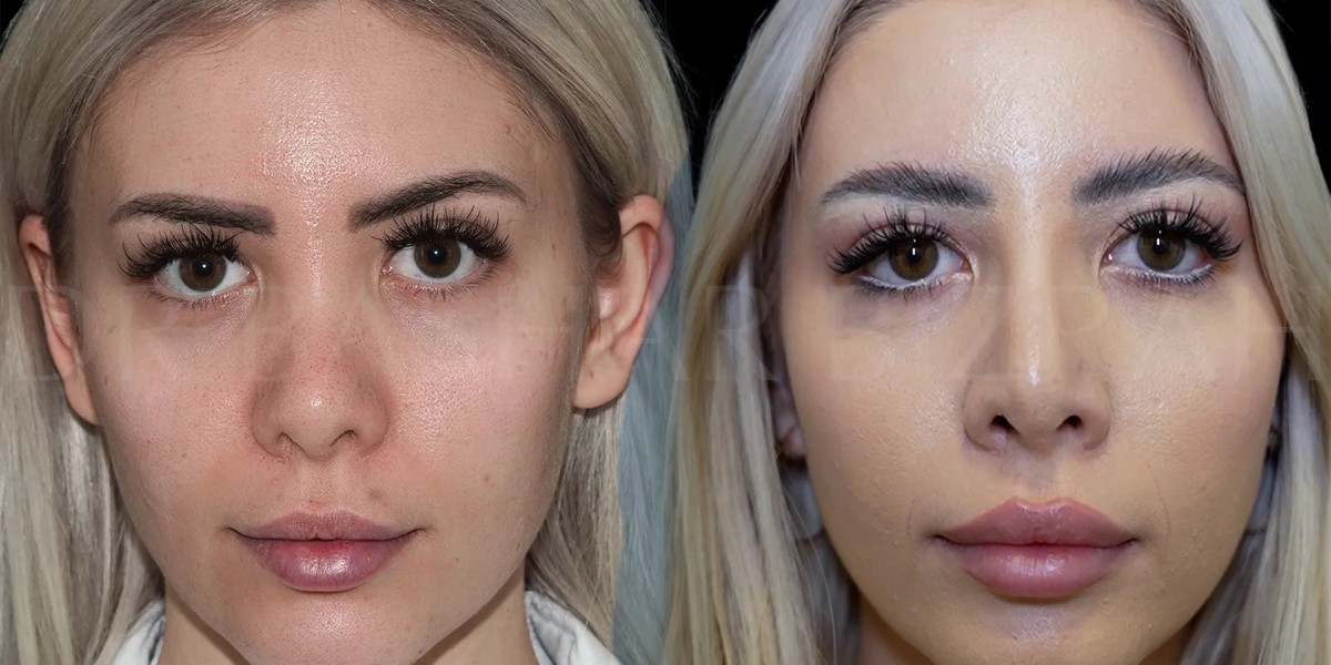 Permanent Cosmetic Nose Surgery Solutions in Islamabad