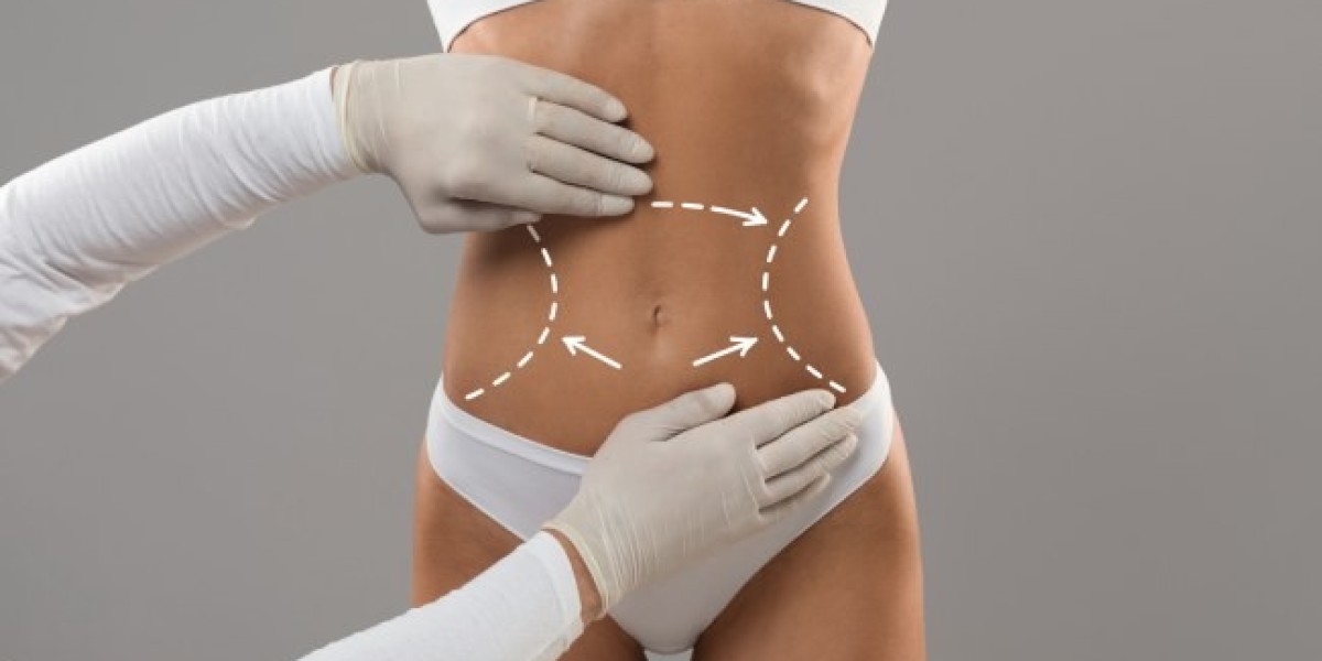 Belt Lipectomy in Riyadh: The Gold Standard for Post-Sleeve Recovery
