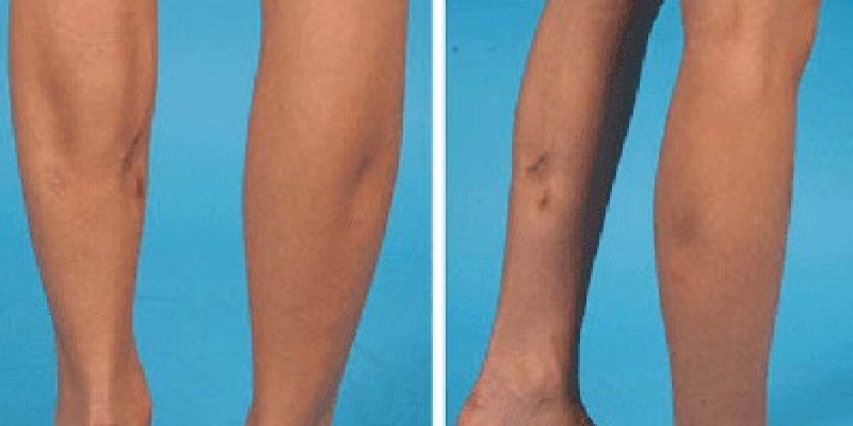 Calf Reduction in Riyadh: Everything You Need to Know Before Your Procedure