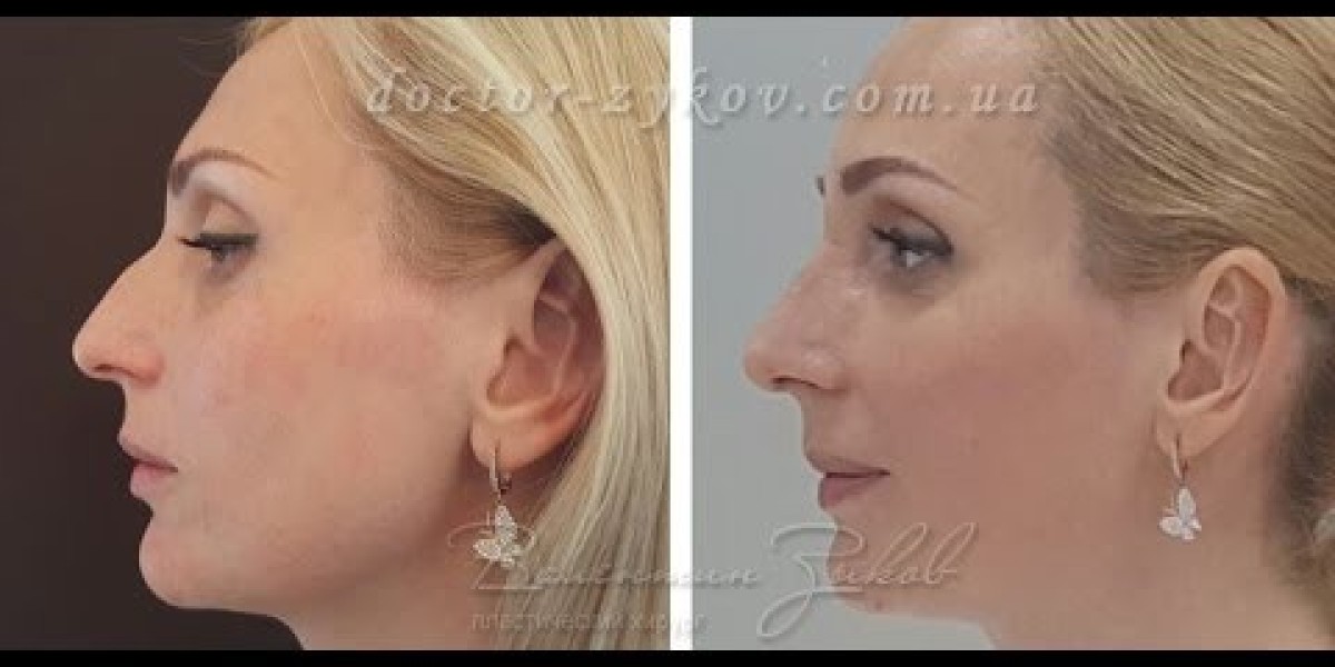 Rhinoplasty in Riyadh: Managing Expectations for Natural Results