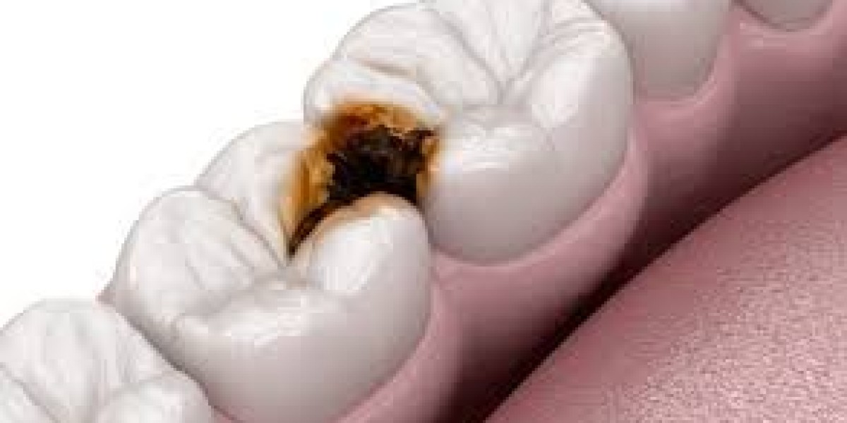 Black Stuff on Teeth: Common Causes and Cleaning Tips