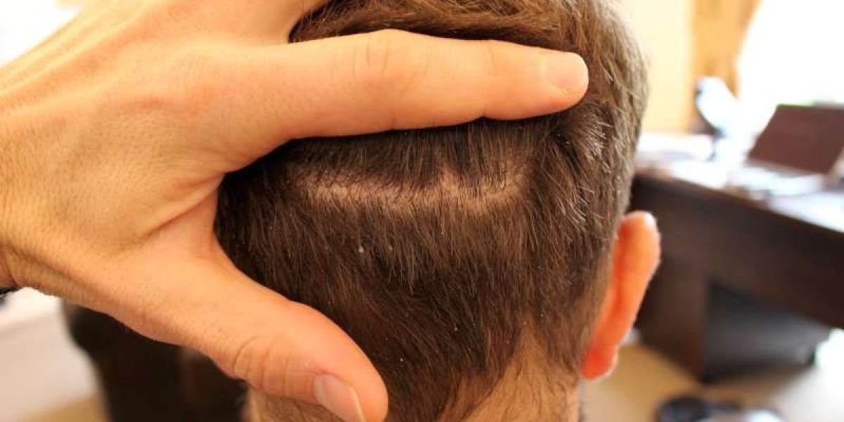 Hair Transplant in Riyadh: Permanent Solutions for Lasting Confidence