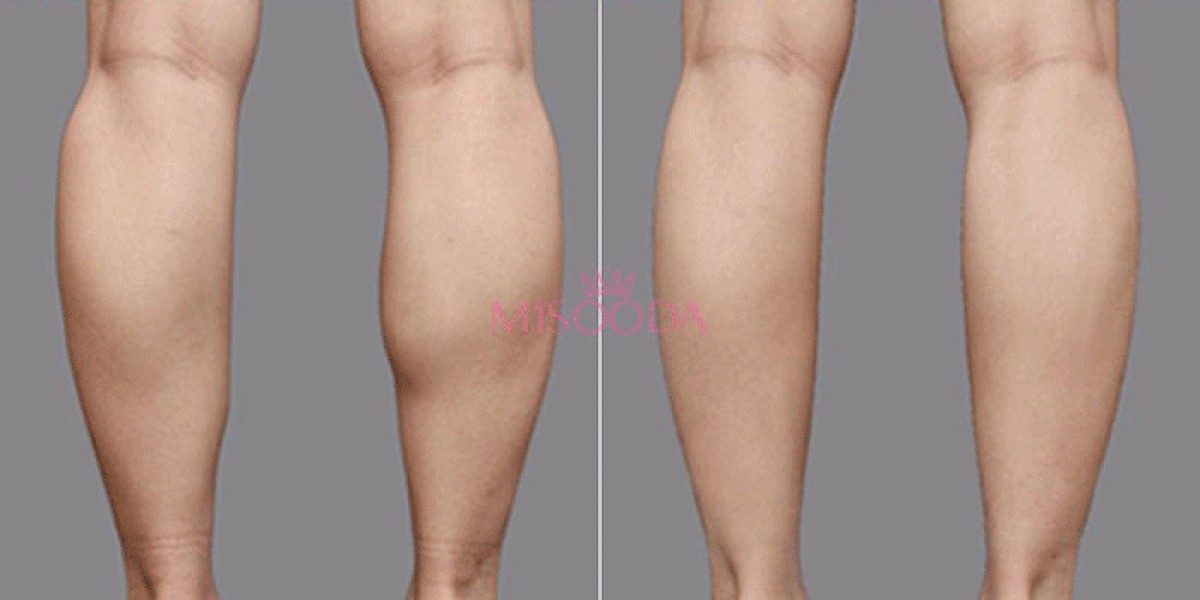 Modern Leg Contouring: Moving Beyond Traditional Liposuction