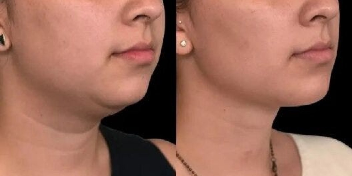 How to Get a Sharper Profile: Leading Double Chin Treatments in Riyadh