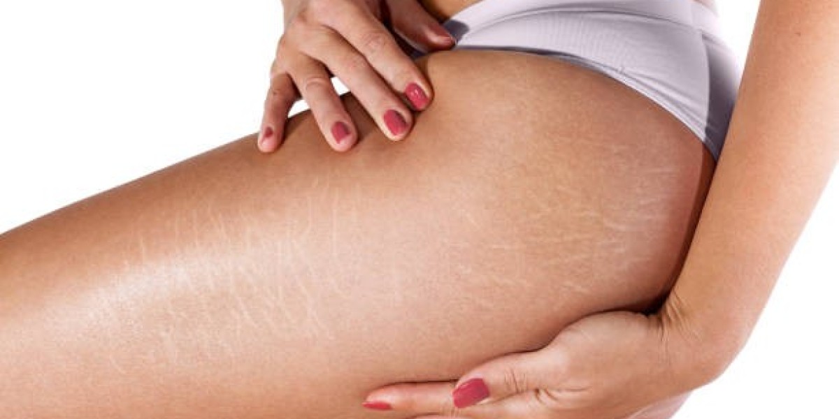 Stretch Mark Removal in Dubai: Best Treatment Guide