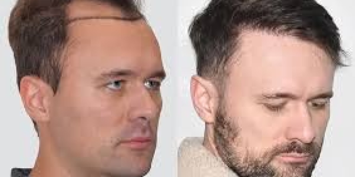 Hair Transplant Cost in Dubai Cost vs Value Explained