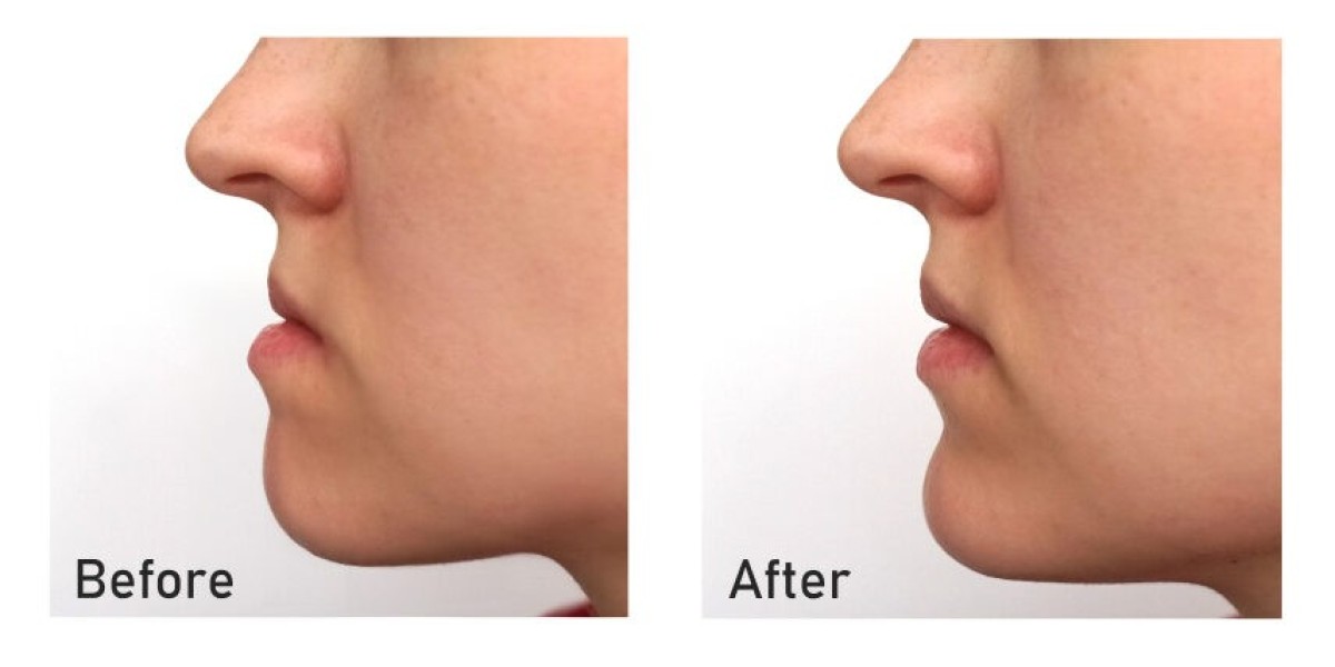 The Ultimate Guide to Cosmetic Jaw Surgery
