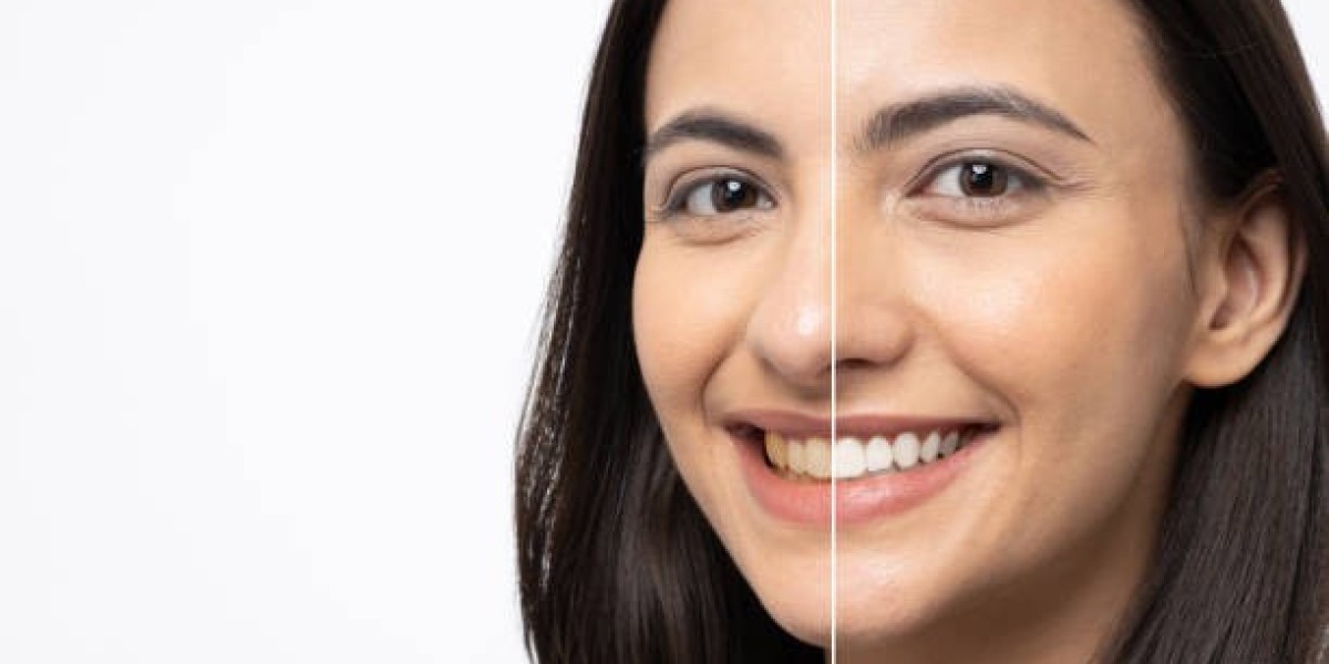 Upgrade Your Smile Effortlessly with Dental Veneers