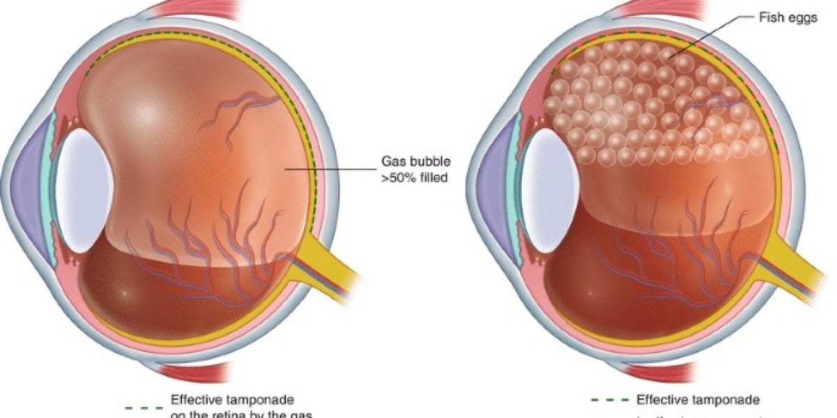 Vitreous Tamponades Market to Reach US$ 117.8 Mn by 2034