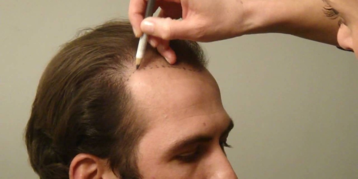 Latest FUE Hair Transplant Technology in Islamabad