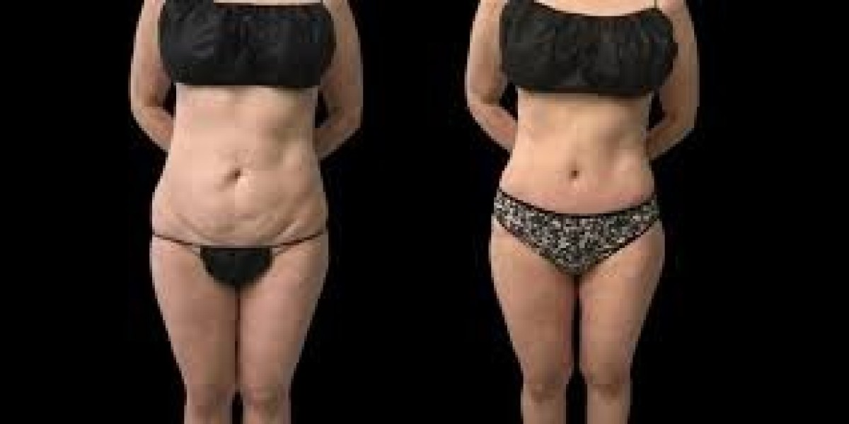 Post-Weight Loss Surgery in Dubai Diet Adjustment Plan