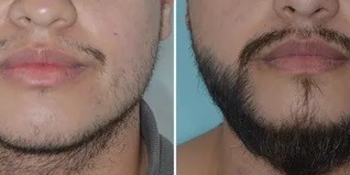 Beard Hair Transplant FAQs for Islamabad Patients