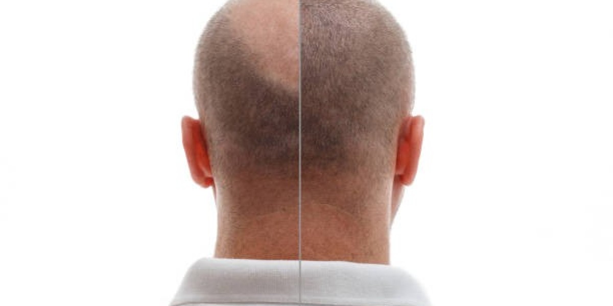 Hair Transplant Before and After: Saudi Arabia Realities