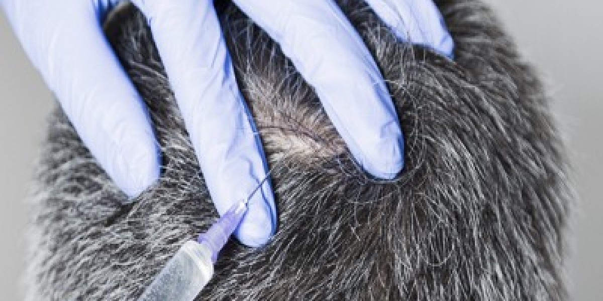 Hair Treatment (PRP) Timeline of Results and Recovery