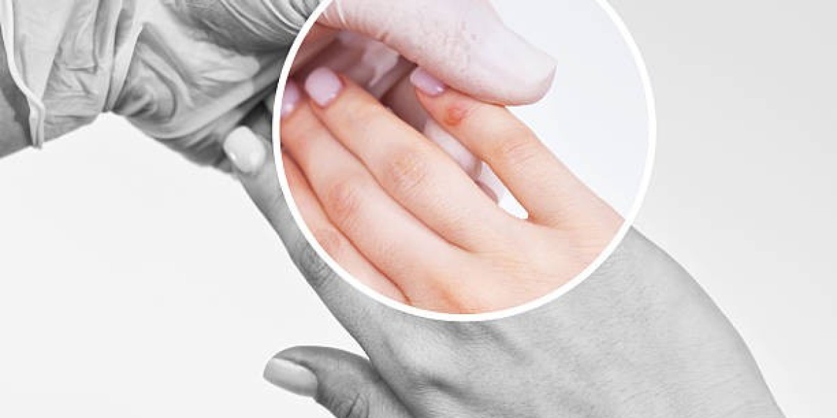 Specialized Laser Wart Removal in Dubai for Men and Women