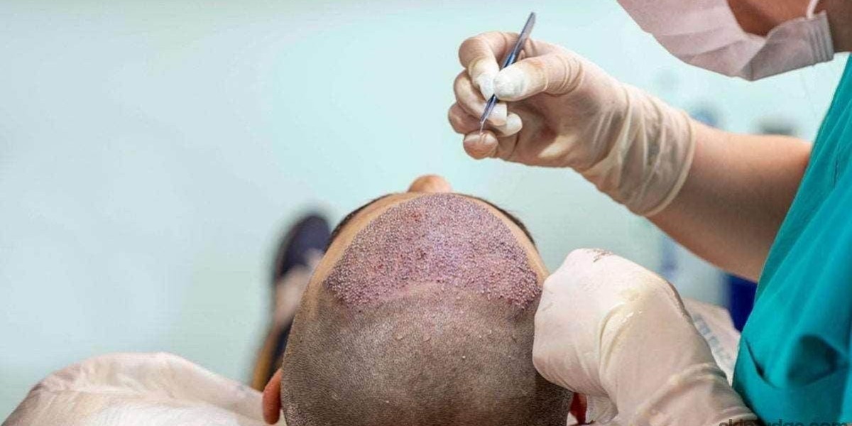 Professional Hairline Refinement at Medixo Aesthetic Clinic