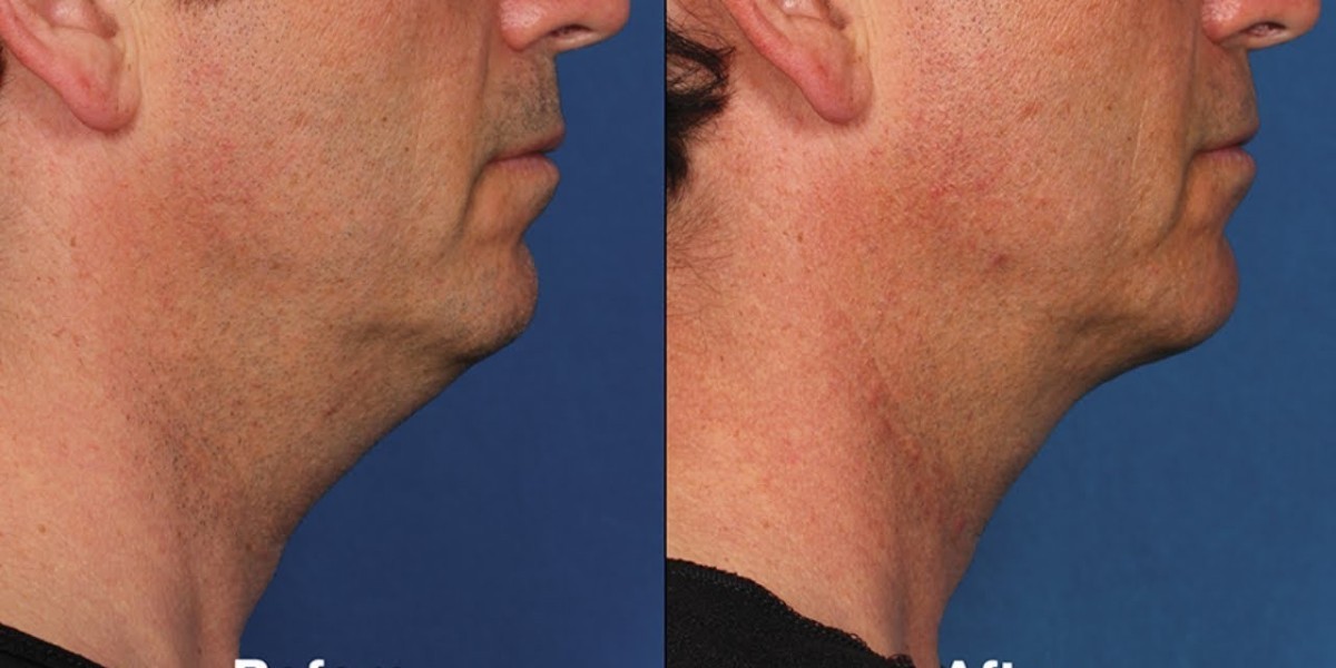 Non-Surgical vs. Surgical Double Chin Removal: Finding Your Best Fit