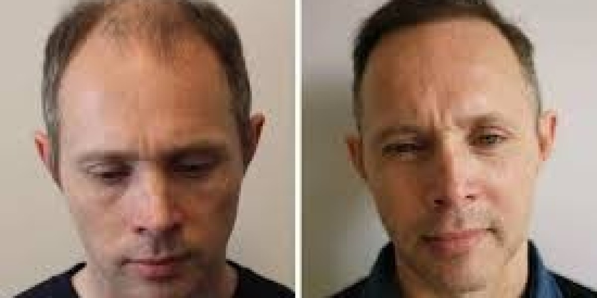 Hair transplant in Dubai PRP Combination Treatment