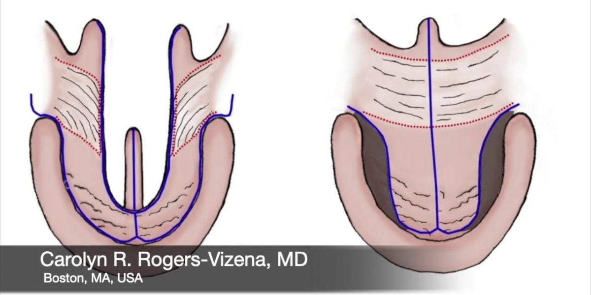 Improving Speech and Function: Palate Repair Surgery in Riyadh