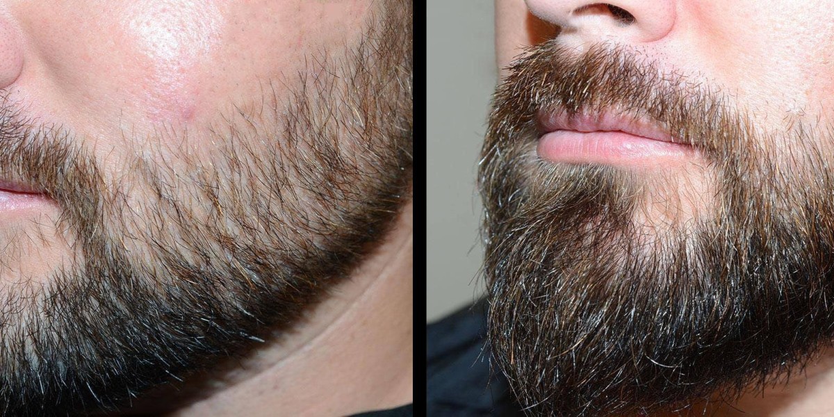 Moustache Transplant in Islamabad: A Safe Cosmetic Solution
