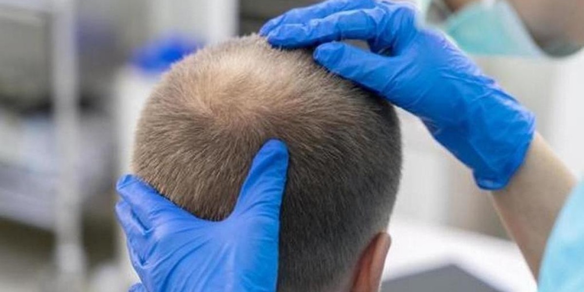 حجز زراعة الشعر بالرياض