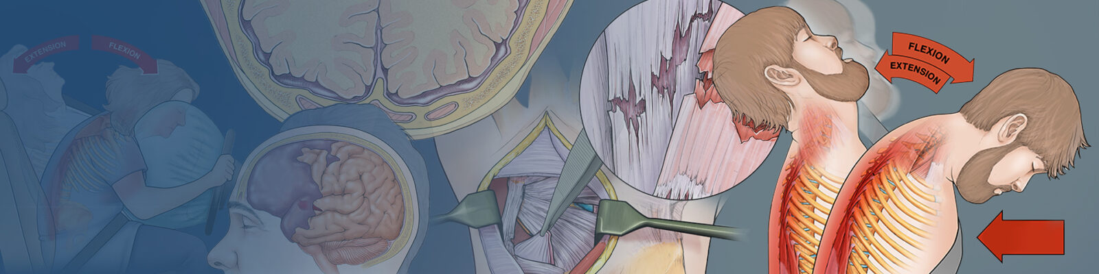 Medical Legal Illustrations | Artery Studios