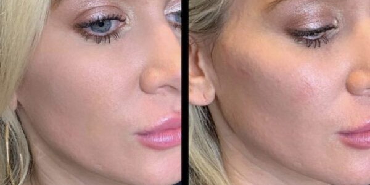 Preparing for Your Appointment: A Checklist for Cheek Enhancement Success