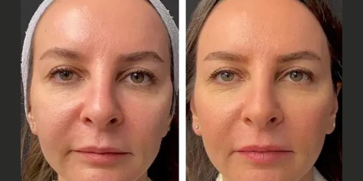 Mesotherapy Treatments in Dubai: Combining with Other Skin Treatments