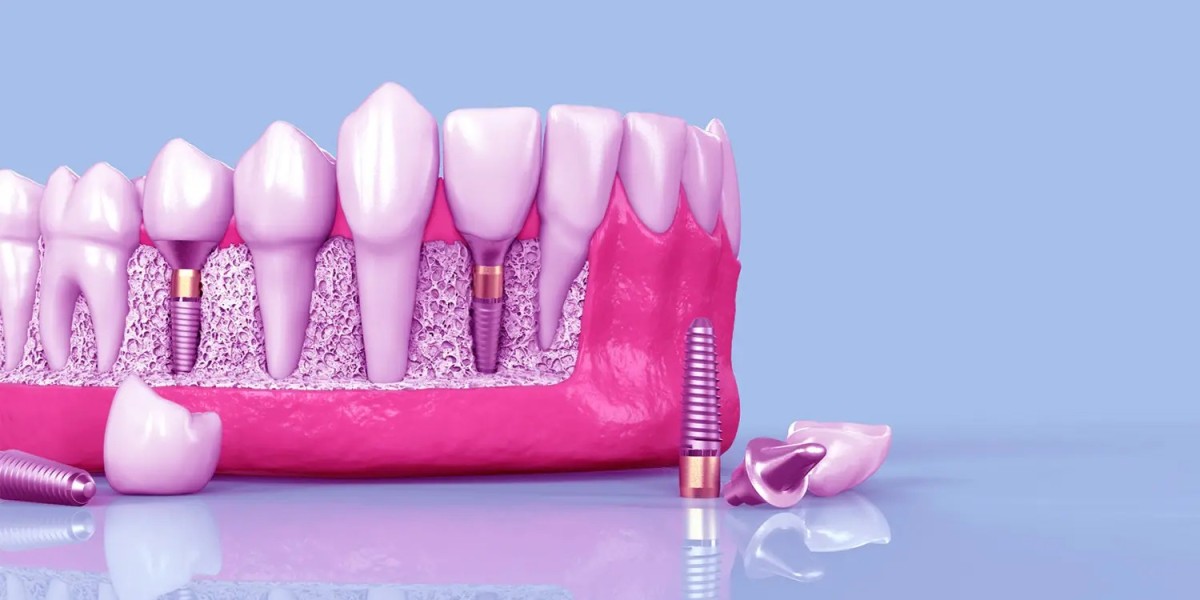 Dental Implants in Dwarka – Restore Your Smile with Confidence