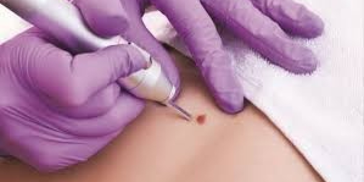 Mole Remvoal in Dubai Safe Skin Treatment Guide 2026