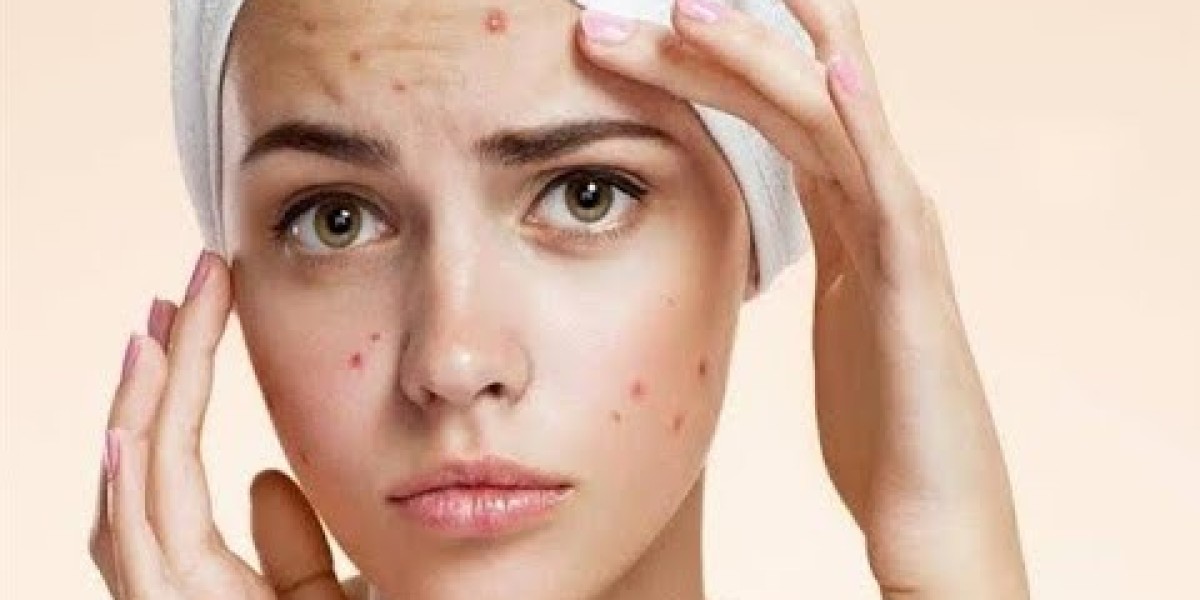 Pimples Treatment in Dubai for Men and Women