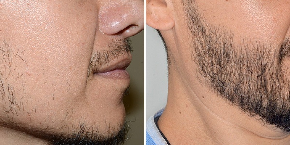 Beard Hair Transplant in Dubai for Beard Density Improvement