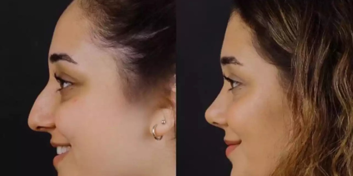Rhinoplasty in Dubai: Healing Timeline Explained