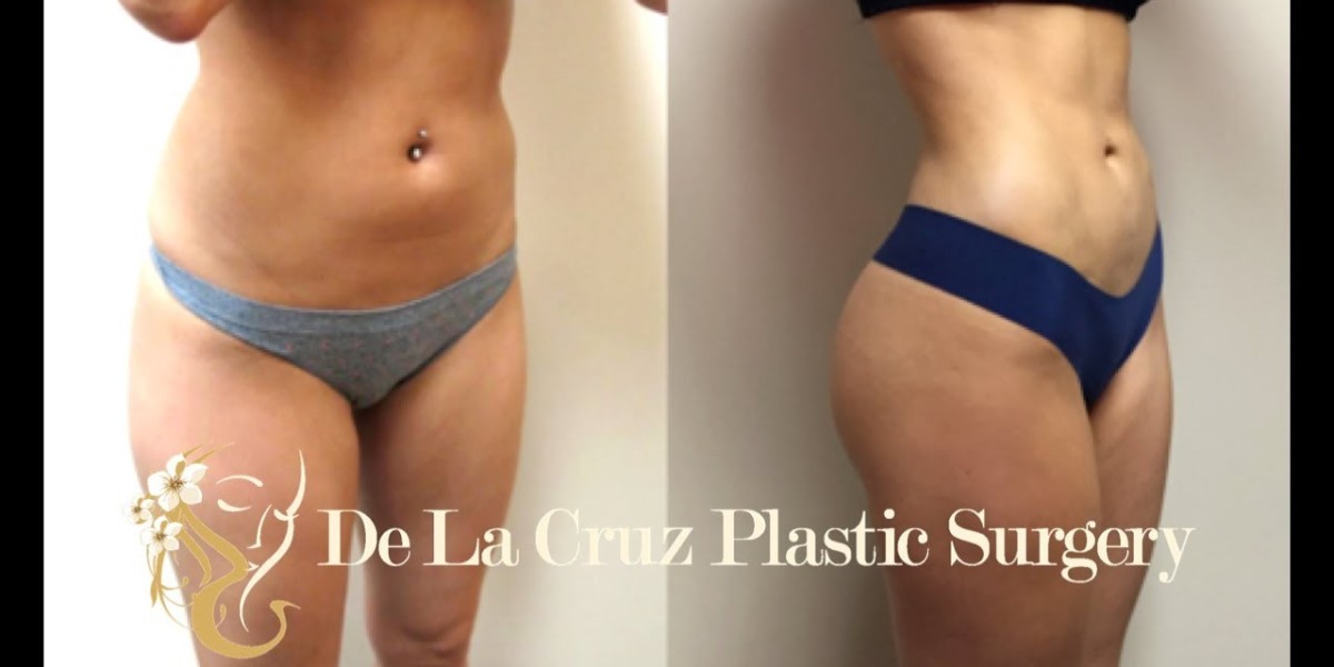 Transform Your Body Shape with Advanced 4D Liposuction