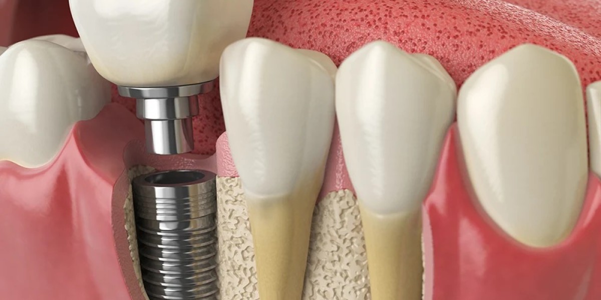Cost of dental implants Essential insights before choosing treatment