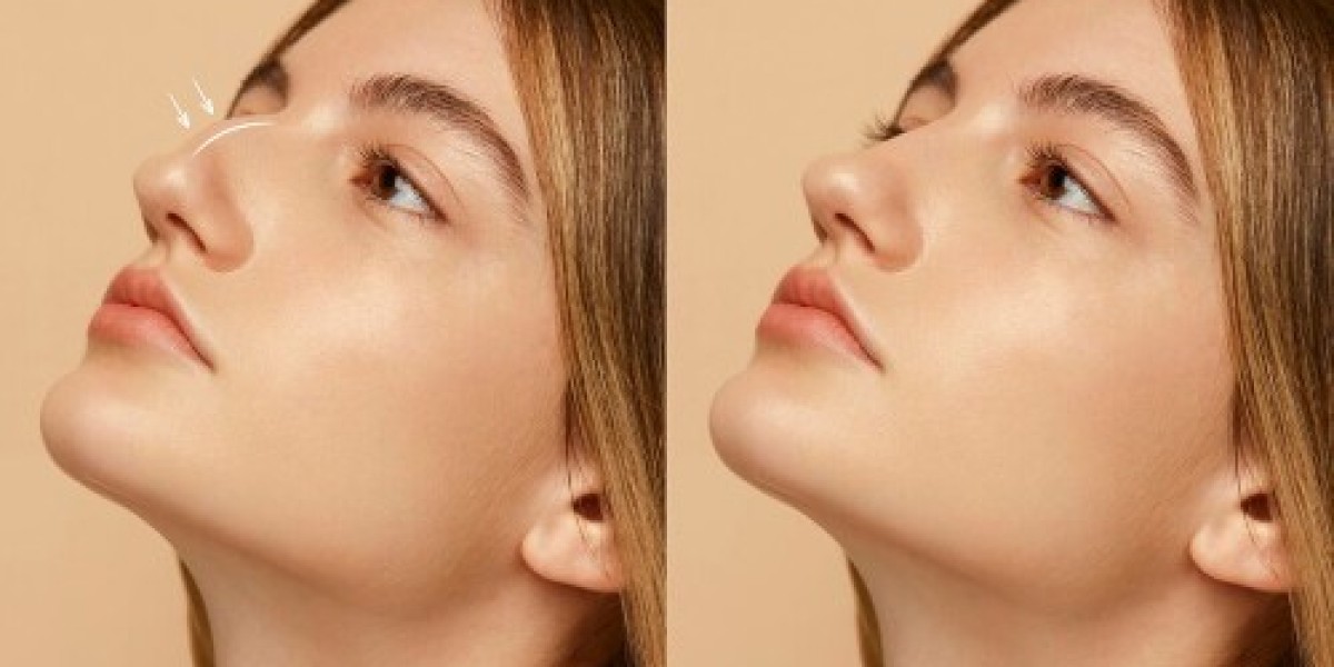 Botox for Nose in Dubai: Non-Invasive Beauty Fix