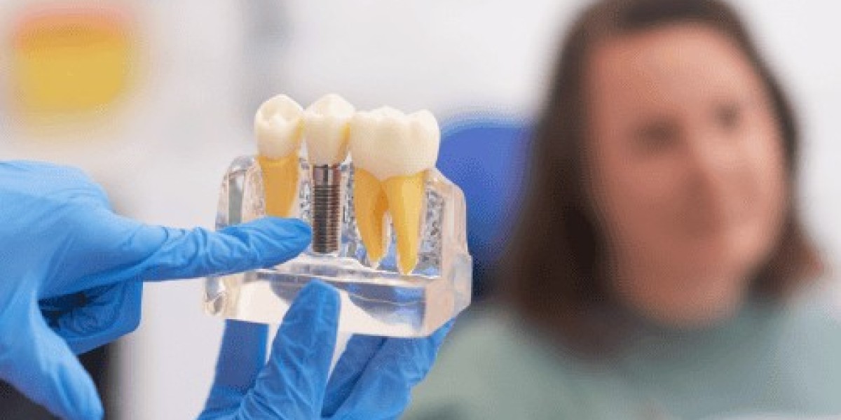 Dental Implant Treatment Is Not Your Only Option — Surprising Alternatives Worth Knowing