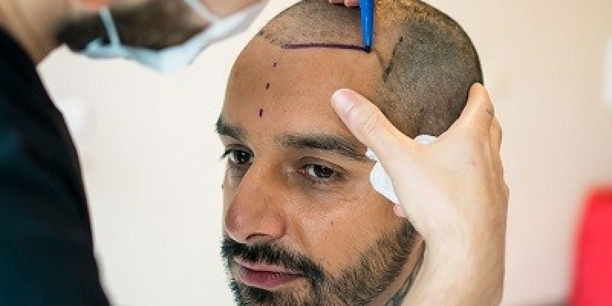 Hair Transplant in Dubai Hairline Design Importance Guide