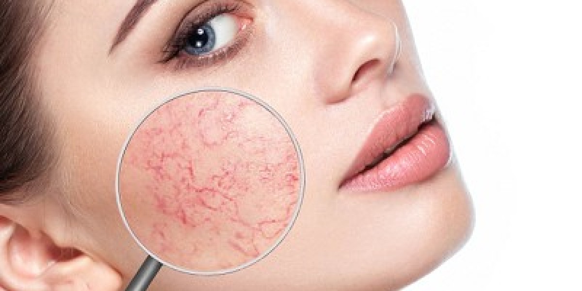 How Rosacea Treatment in Islamabad Can Reduce Facial Flushing
