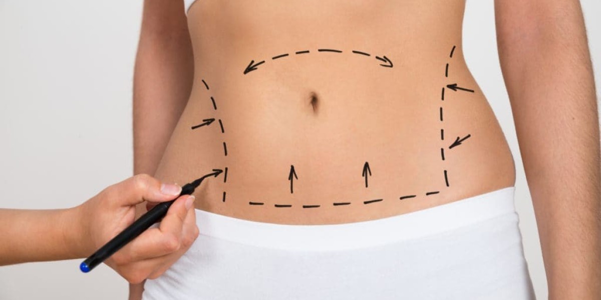Abdominoplasty in Dubai vs Liposuction: Key Differences