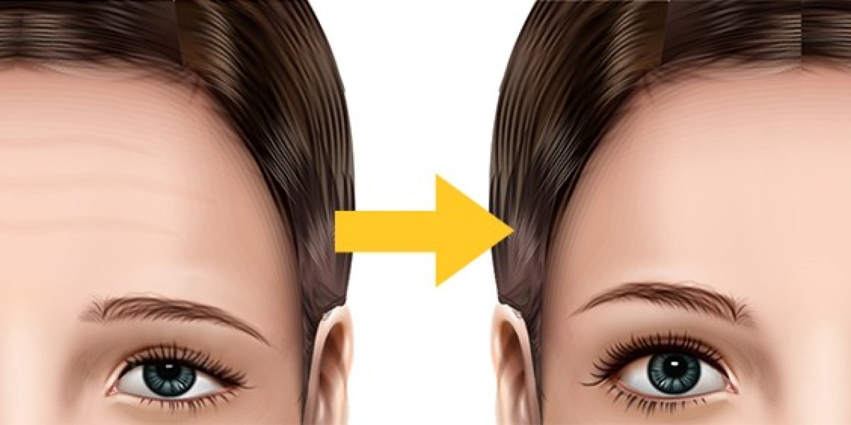 Smooth and Serene: How a Forehead Lift Refreshes Your Look in Riyadh