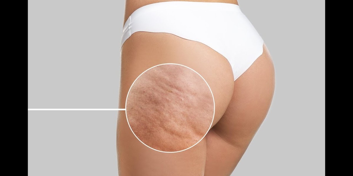 Get Flawless Skin with Cellulite Removal in Islamabad