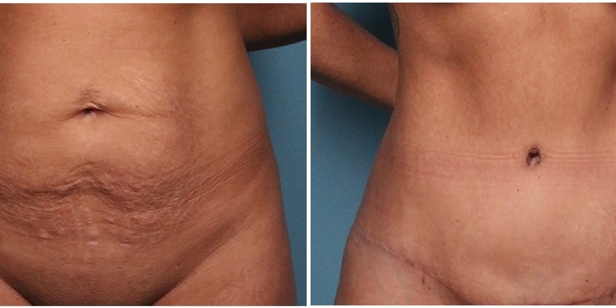 Tummy Tuck Results: Transforming Your Post-Pregnancy Body