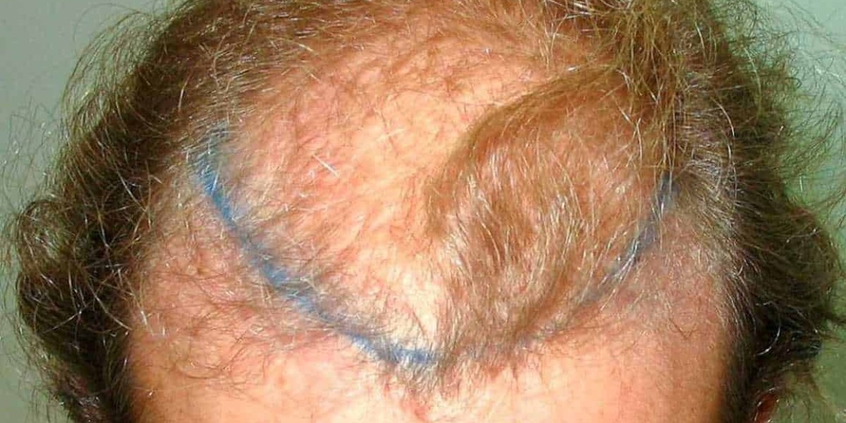 Is FUT Hair Transplant Worth It in Islamabad?