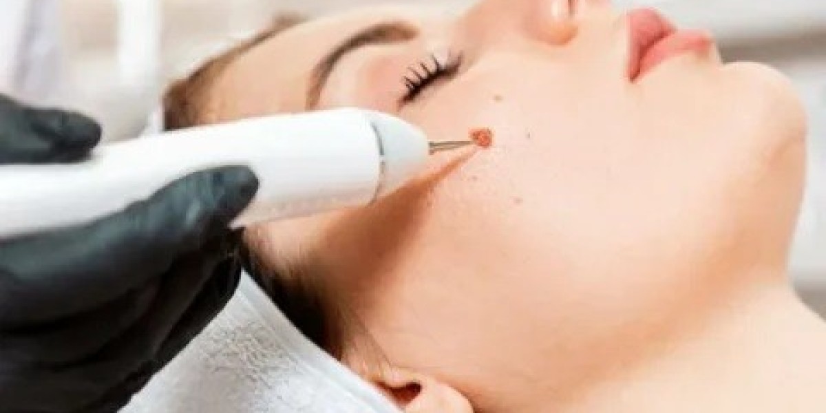 Wart Removal for Busy Professionals in Islamabad