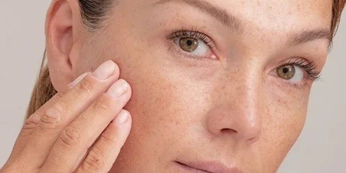 Clinics Offering the Best Melasma Care in Islamabad